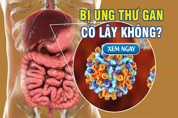 Giải đáp thắc mắc: “Bị ung thư gan có lây không?”. Xem ngay!